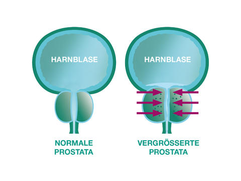 Grafische Darstellung des Vergleichs zwischen einer normalen Prostata und einer vergrößerten Prostata